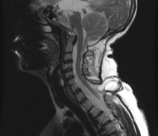 Chiari malformatiók Hátsó scala rendellenességei