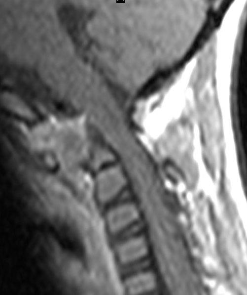 Rheumatoid arthritis Pannus a dens körül Dens-CI elülső íve közötti távolság nő Atlanto-axiális