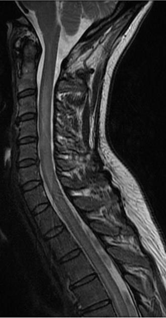 Gyulladásos folyamatok Spondylodiscitis