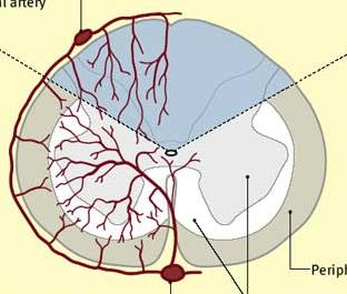 Myelopathia T2 magas intenzitás Okok Vascularis AV fistula,