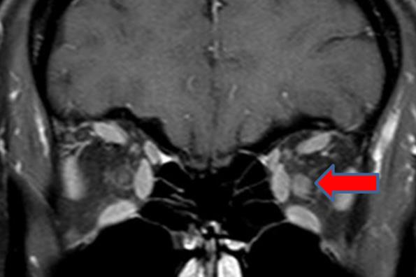 Neuromyelitis optica