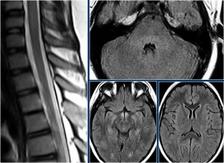 Acute disseminált encephalomyelitis ADEM Vírus