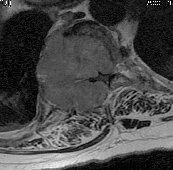 Tumorok Extraduralis csonttumorok metastasis Intraduralis - extramedullaris meningeoma