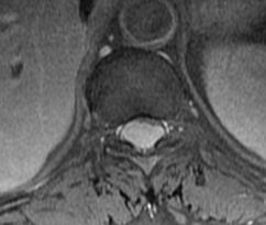 Tumorok Extraduralis csonttumorok metastasis Intraduralis - extramedullaris meningeoma neurinoma