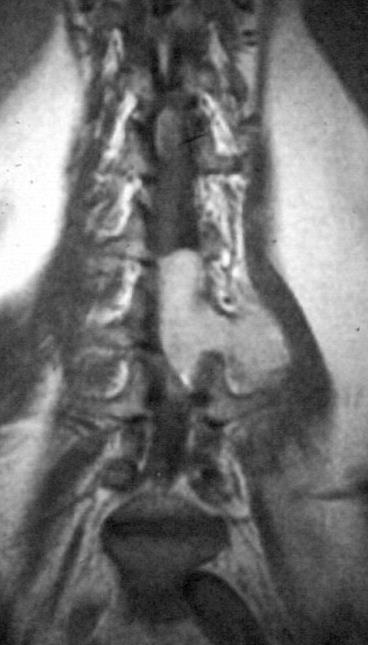 Tumorok Extraduralis csonttumorok metastasis Intraduralis - extramedullaris meningeoma