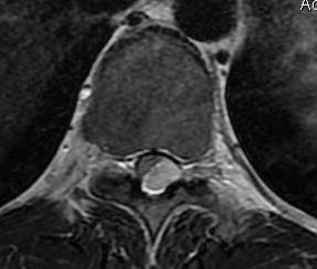 Tumorok Extraduralis csonttumorok metastasis Intraduralis - extramedullaris meningeoma