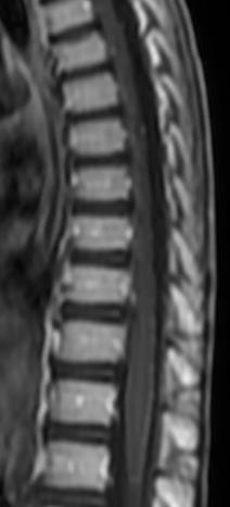 Tumorok Extraduralis csonttumorok metastasis Intraduralis - extramedullaris meningeoma neurinoma/neurofibromatois