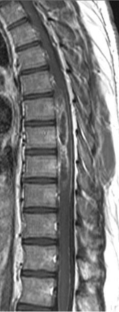 Tumorok Extraduralis csonttumorok metastasis Intraduralis - extramedullaris meningeoma neurinoma