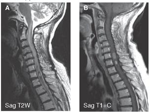 Tumorok Extraduralis csonttumorok metastasis Intraduralis - extramedullaris meningeoma neurinoma metastasis Intramedullaris