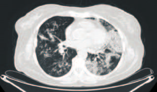 bronchoscopos tüdőbiopsiát végeztek (más intézményben). Ennek eredménye adenocarcinoma lett, az immunhistologia TTF-1 és CK-7 pozitivitást, valamint CK-20 és CE negativitást mutatott.