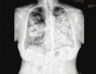 ábra mutatja, hogy a kétoldali adenocarcinoma nagy kiterjedésben jelen maradt 1 hónappal (2008. július, ) és 5 hónappal (2008. november, ) a cisplatin-gemcitabin terápia után is.