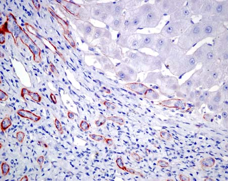 1. Agrin expresszió ép és cirrhotikus humán májszövetben A normál májban, illetve tumor melletti ép májszövetekben az agrin a portális térben, az erek és az epeutak bazális membránjában fordult elő.