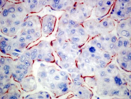 Az agrin protein expressziót 35 formalinban fixált, paraffinba ágyazott HCC-n vizsgáltuk.