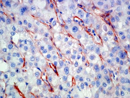 A vártnak megfelelően a CD34 expressziója megegyezett az agrin protein expressziójával a HCC-ben (8.D. ábra).