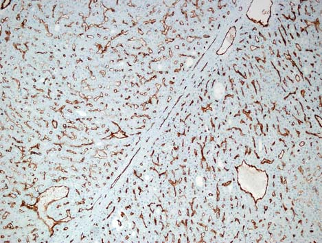 Egyes területeken erős immunopozitivitás látható a szinuszoidoknak megfelelő képletek mentén (A, C), míg máshol a