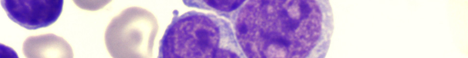 (C) A kenetben a CLL lymphocytái (*) mellett nagy, közepesen széles cytoplasmájú, laza kromatin szerkezetű multiplex nucleolust tartalmazó centroblast sejtek