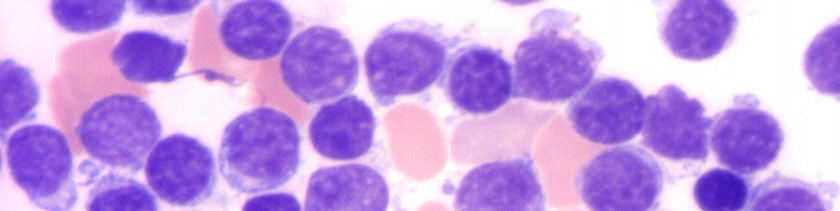 III.1.1 A B-CLL morfológiája A B-CLL/SLL az érett B-sejtek daganatos betegsége.