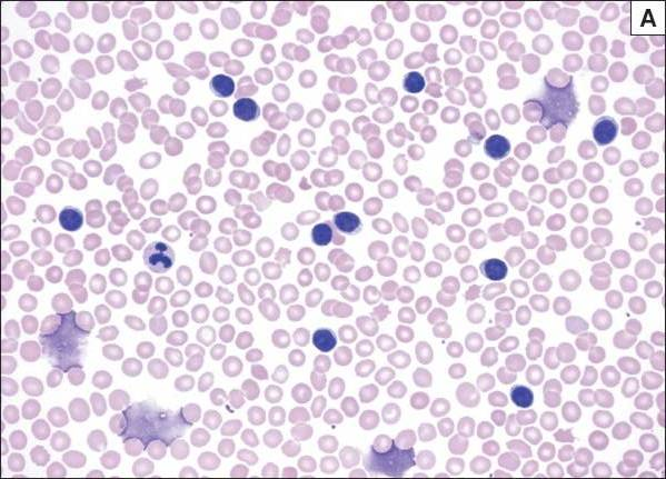 (A) Heterokromatinizált magvú, keskeny, enyhén basophil cytoplasmával rendelkező lymphocyták a beteg vérében.