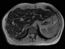 Egyéb T2* GRE axial / coronal gyenge intrinsic lágyrész-kontraszt hasznos SPIO után (axial and