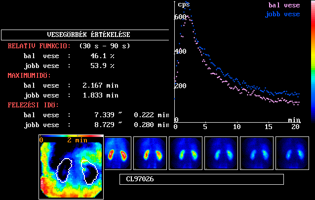Normális dinamikus veseszcintigram Kvantitatív