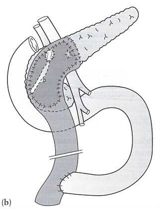Figure 6. Duodenum-preserving pancreatic head resection Figure 7. Spleen-preserving distal pancreatectomy Figure 8. Central pancreatectomy 2.