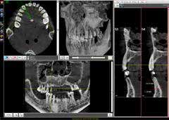 OrisWin DG Suite 3D Keresztmetszeti felvétel a pontos diagnózisért A keresztmetszeti képpel pontosabb