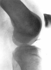 2. ábra A natív röntgenfelvételen a femur mediális condylus teherviselõ felszínérõl letörött nagy osteochondralis fragmentum látható. (L-L felvétel) 3.