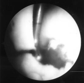 4. ábra. Artroszkópos kép a femur laterális condyluson elhelyezkedõ nagyméretû osteochondralis törésrõl 5.