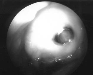 Az artroszkópos csavarkivétel alkal mával készített felvétel 6. ábra Patella osteochondralis törését rögzítõ KFI csavar röntgenképe 7.
