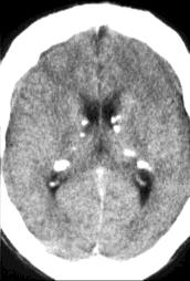 tuberosa Hemimegalencephalia Focalis corticalis