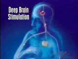 I. Mély agyi stimuláció hatásának vizsgálata DBS műtét alatti mozgásteszt http://www.youtube.