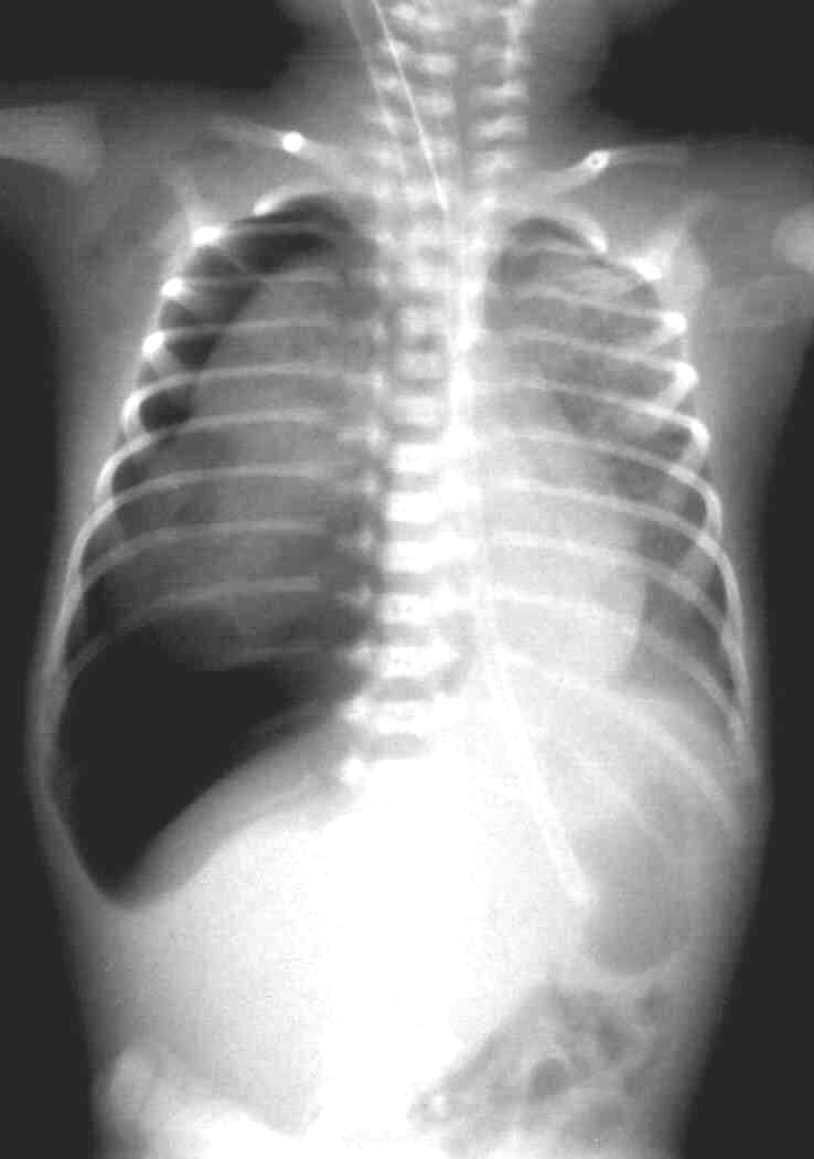 Pneumothorax (PTX)