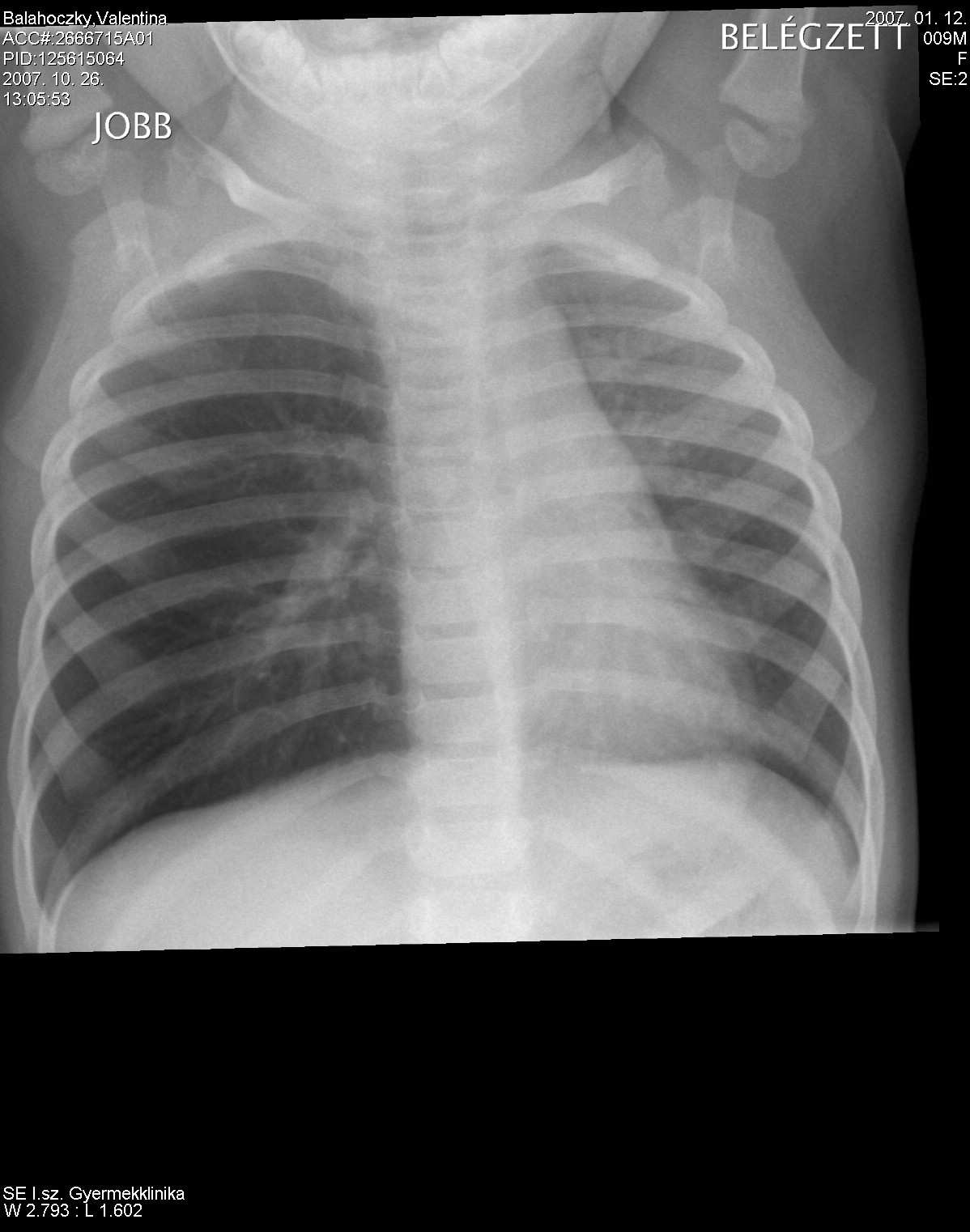 Ki-belégzésben rtg felvétel: a mediastinum a kóros oldal