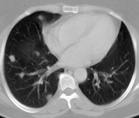 INTRAPULMONALIS TUMOROK Valódi tumor: nagyon ritka gyermekkorban bronchogen cysta, hamartoma, echinococcus