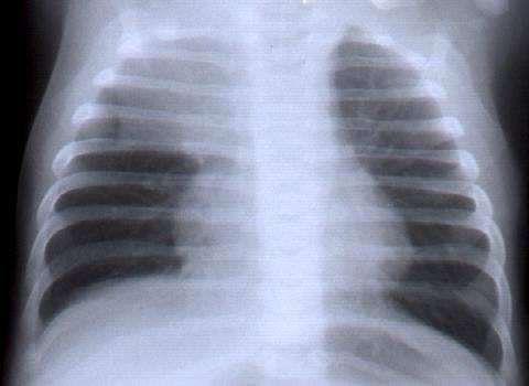 MEDIASTINALIS TERIMÉK THYMUS Normálisan 3 éves