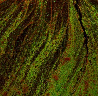 13. ábra: Artériából származó trombusmetszet képe lézer konfokális mikroszkópban.