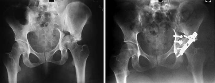 Primer osteosynthesis, majd redislocatio miatt