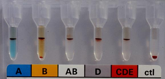 Plusz reakció a baloldalon szerzett B vércsoport vér csoport vörösvérsejt vizsgálata a savó vizsgálata anti-a