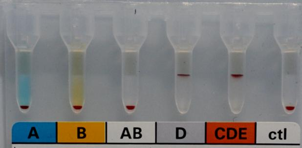 Anti-H lektin - hiányzó H Csató E., Losonczy J., Friss A., Neuhauser J.