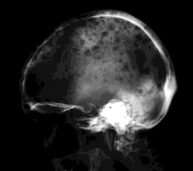 ) Csont-tumorok:primer tumoroknál egyik legfontosabb módszer. 1cm-nél nagyobb metastasis.