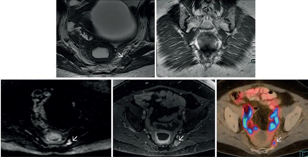 Recidiv rectum tumor.kontroll MR vizsgálat. B.o. m. piriformisban alacsony jelintenzitású terület.