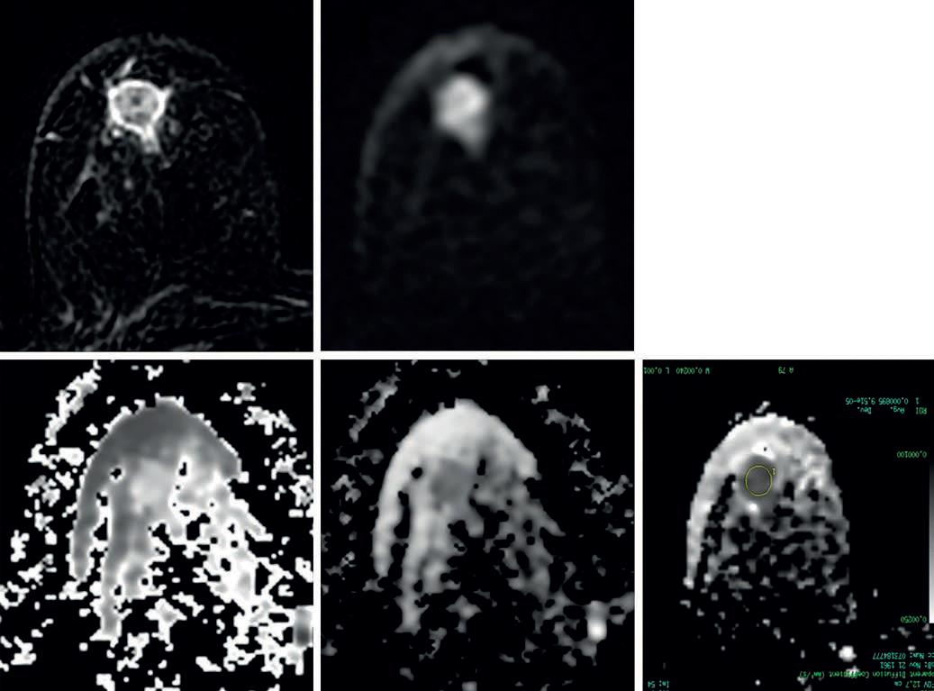 Invazív ductalis carcinoma Kontrasztanyagos T1 kép: intenzív halmozás Diffúziósúlyozott kép: magas