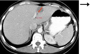 RECIST Baseline Follow-up Korlátok:- ha nem a tumor méretváltozása jelzi a