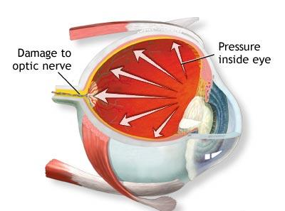 .. zöldhályog Intraocular pressure