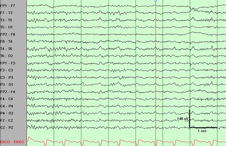 ECG artefact EEG és