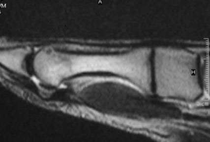 B: A nidus csak retrospektíve ismerhető fel az MRI felvétel