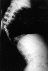 Az ábra a mûtét elõtt és 4 évvel a mûtét után készített a-p röntgenfelvételeken a jobbra konvex thoracalis scoliosist