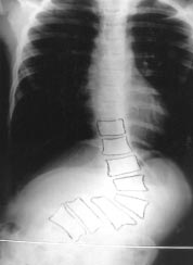 D C 3. ábra c. Közvetlen mûtét elõtt készült röntgenfelvételen látjuk a rövid szegmentumú görbületet, ekkor nagysága 70 fok. d.