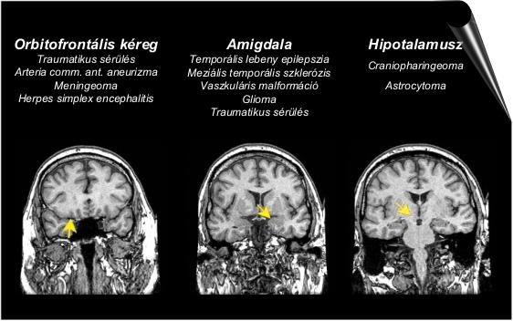 The anterior cingulate orbitofrontal connection is also crucial for assigning emotional valence to social stimuli.