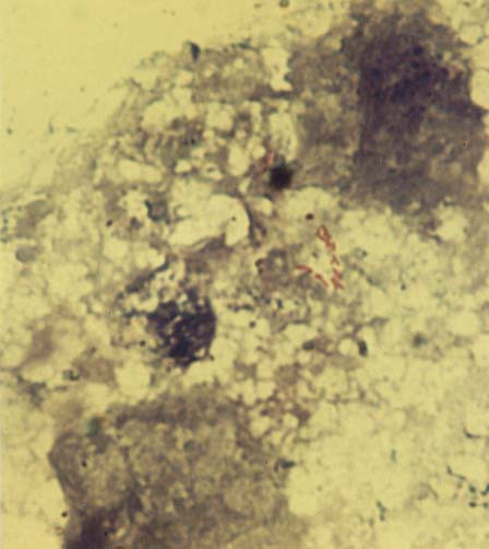 Ziehl-Neelsen staining: Mycobacterium tuberculosis in sputum